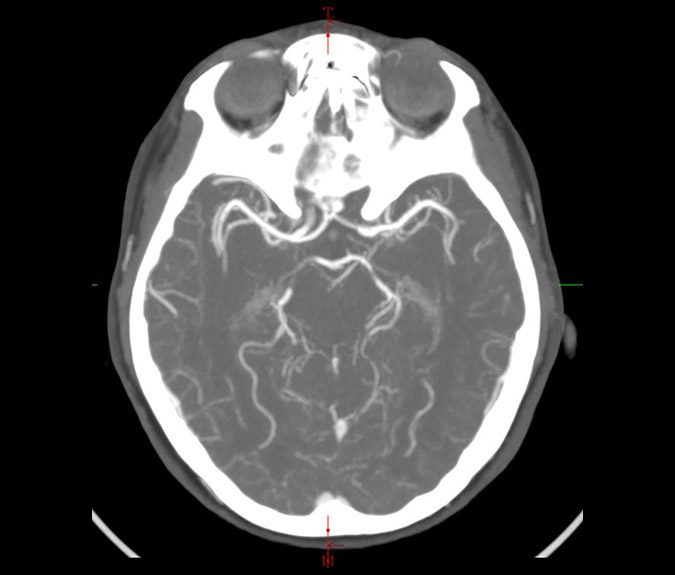 Ct Brain Angiogram
