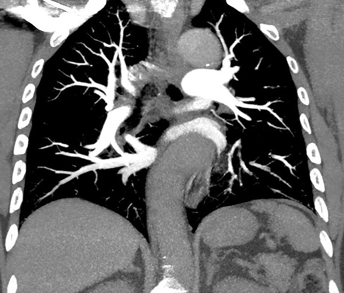 Ct Pulmonary Angiogram