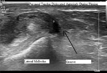 Truumatic Dislocation (2)